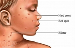 Các bệnh truyền nhiễm trong mùa Xuân và cách phòng chống