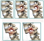Trượt đốt sống - Bệnh không thể xem thường